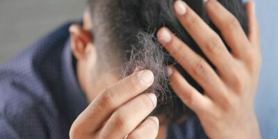 Hair Loss