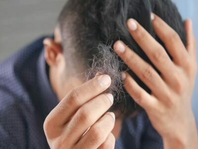 Hair Loss